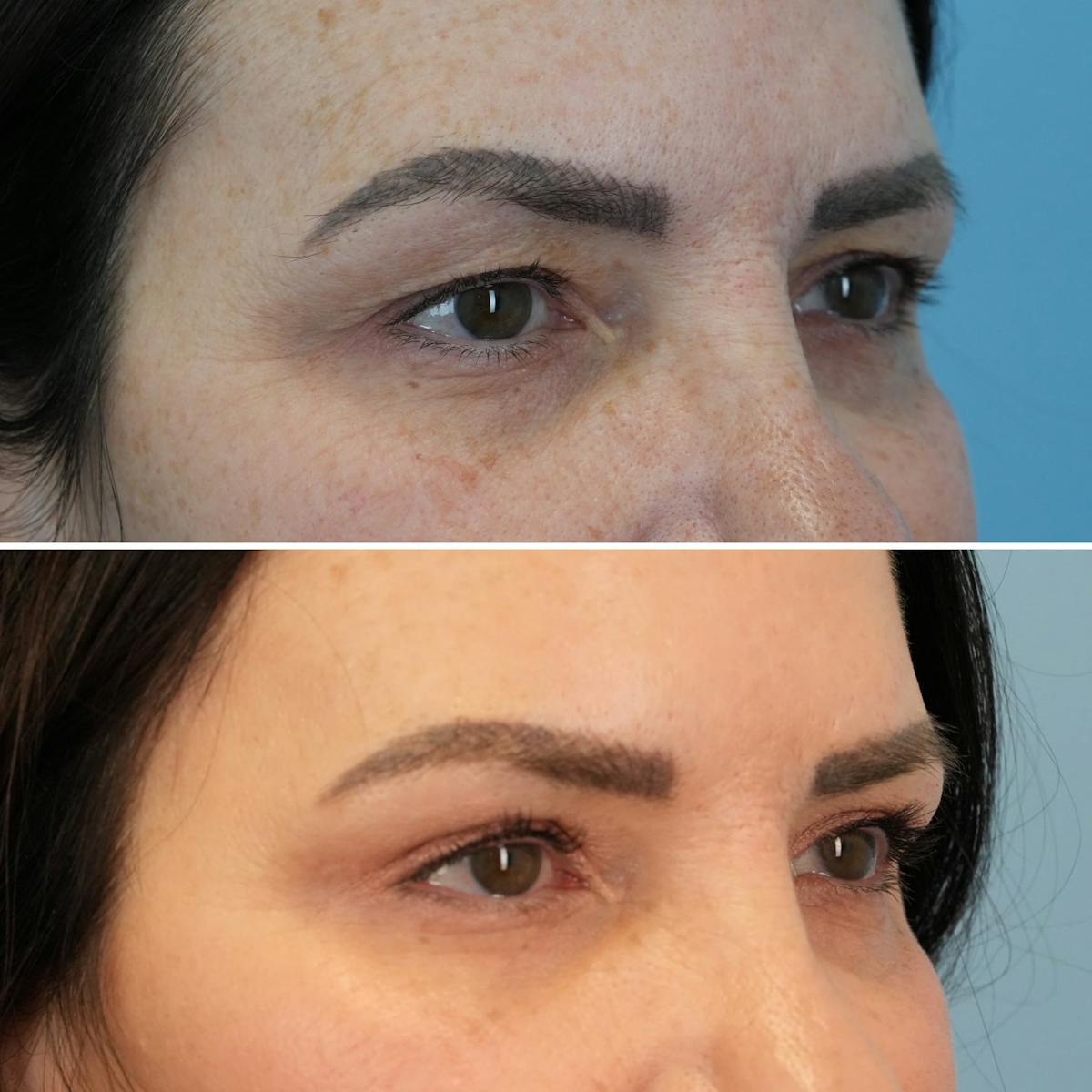 Blepharoplasty Before & After Gallery - Patient 399438 - Image 2