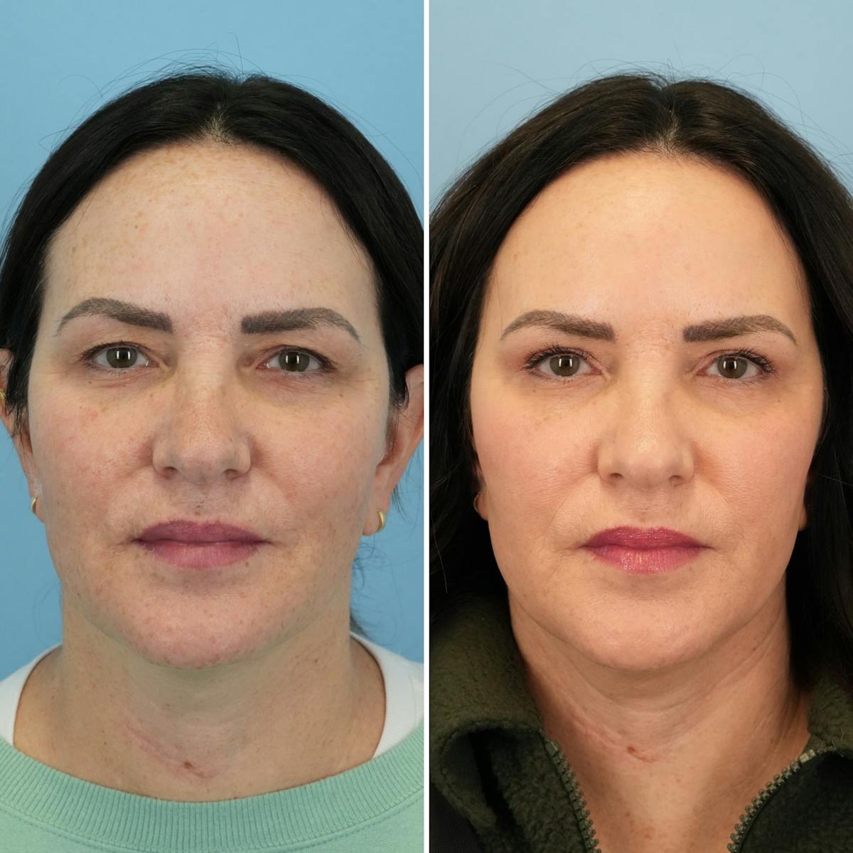 Blepharoplasty Before & After Gallery - Patient 399438 - Image 3