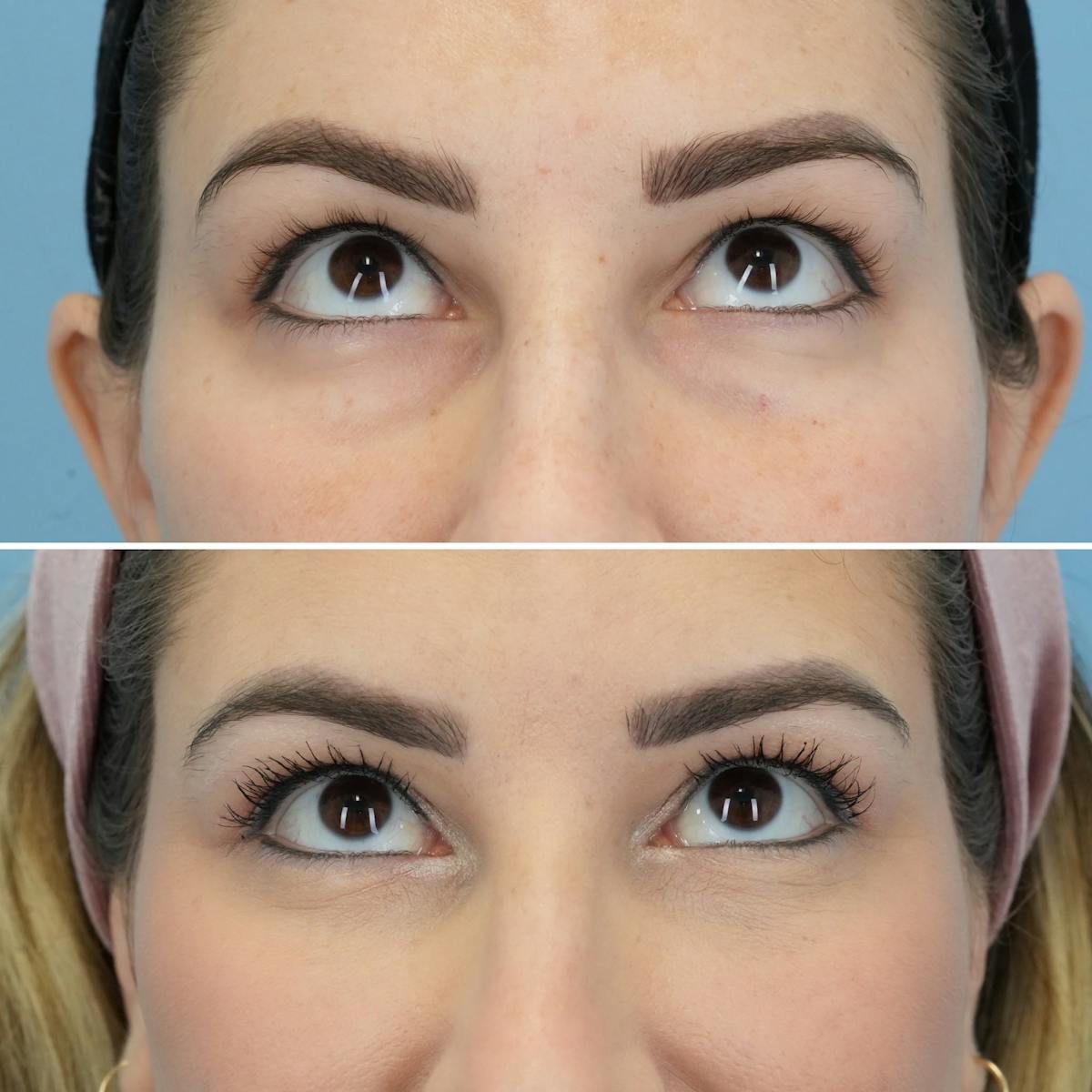 Blepharoplasty Before & After Gallery - Patient 116292 - Image 2