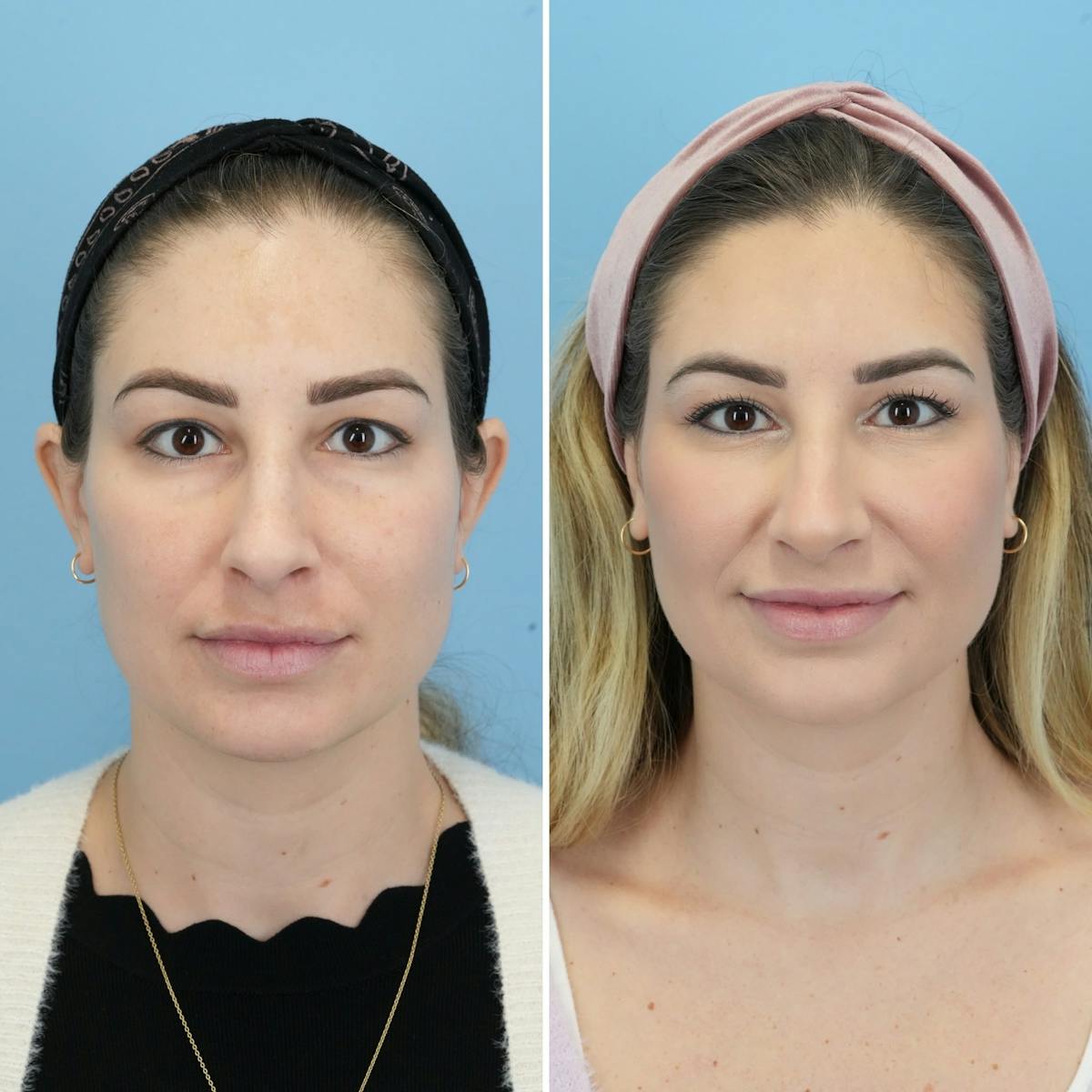 Blepharoplasty Before & After Gallery - Patient 116292 - Image 5