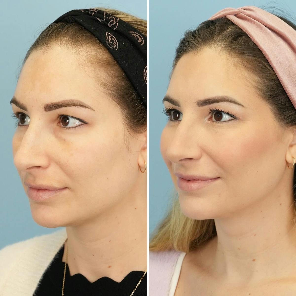 Blepharoplasty Before & After Gallery - Patient 116292 - Image 6