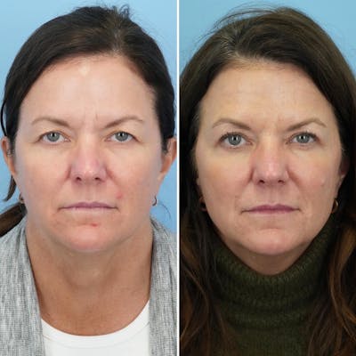 Blepharoplasty Before & After Gallery - Patient 248638 - Image 1