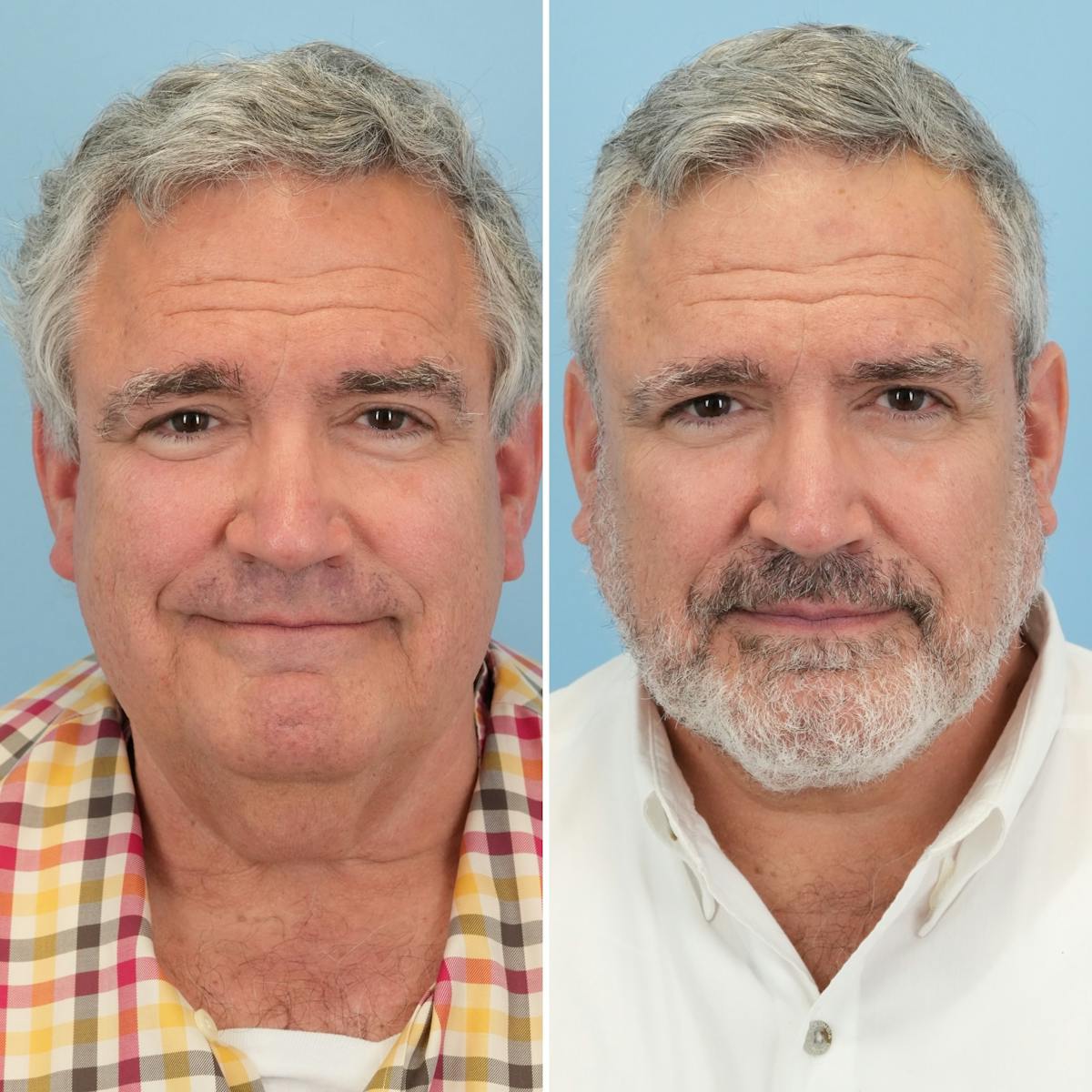 Facelift Before & After Gallery - Patient 314822 - Image 1