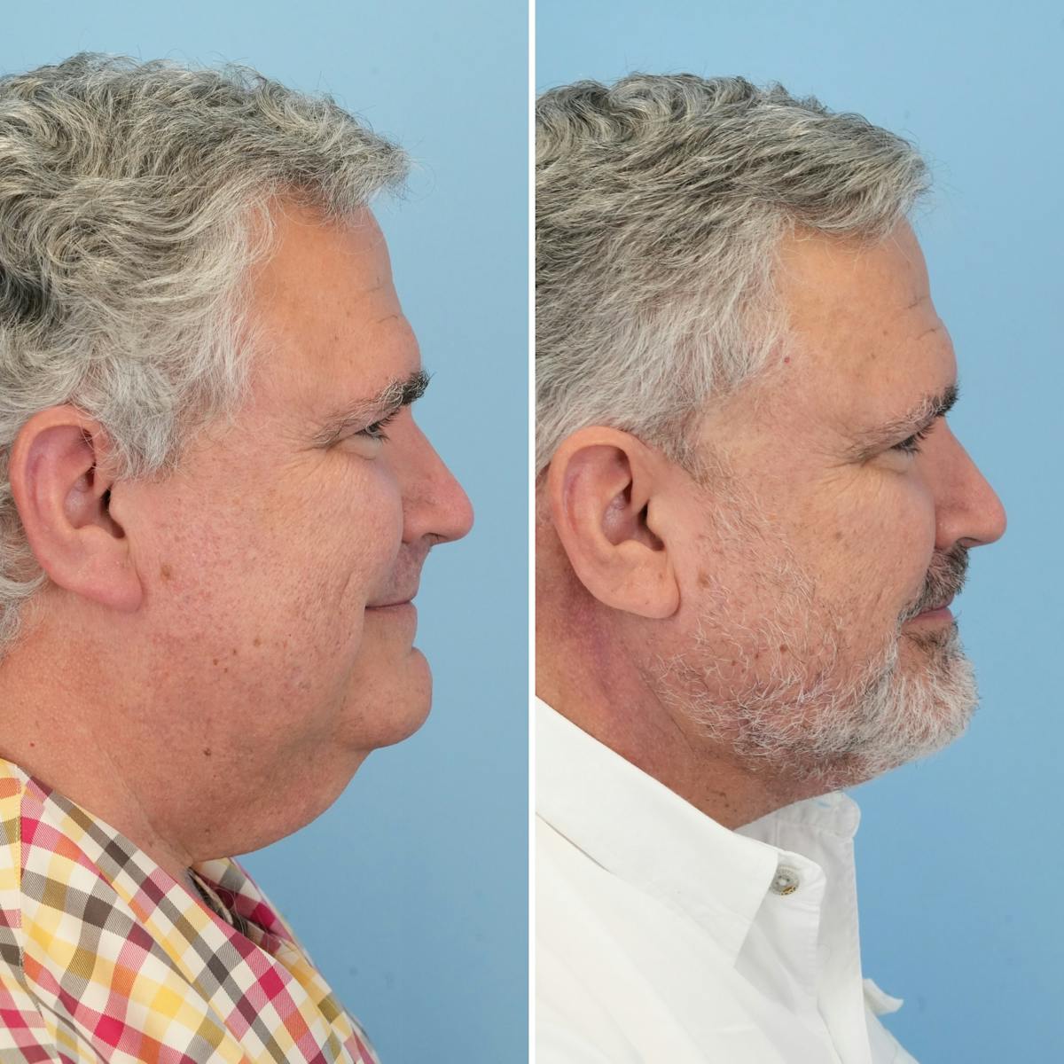 Facelift Before & After Gallery - Patient 314822 - Image 3