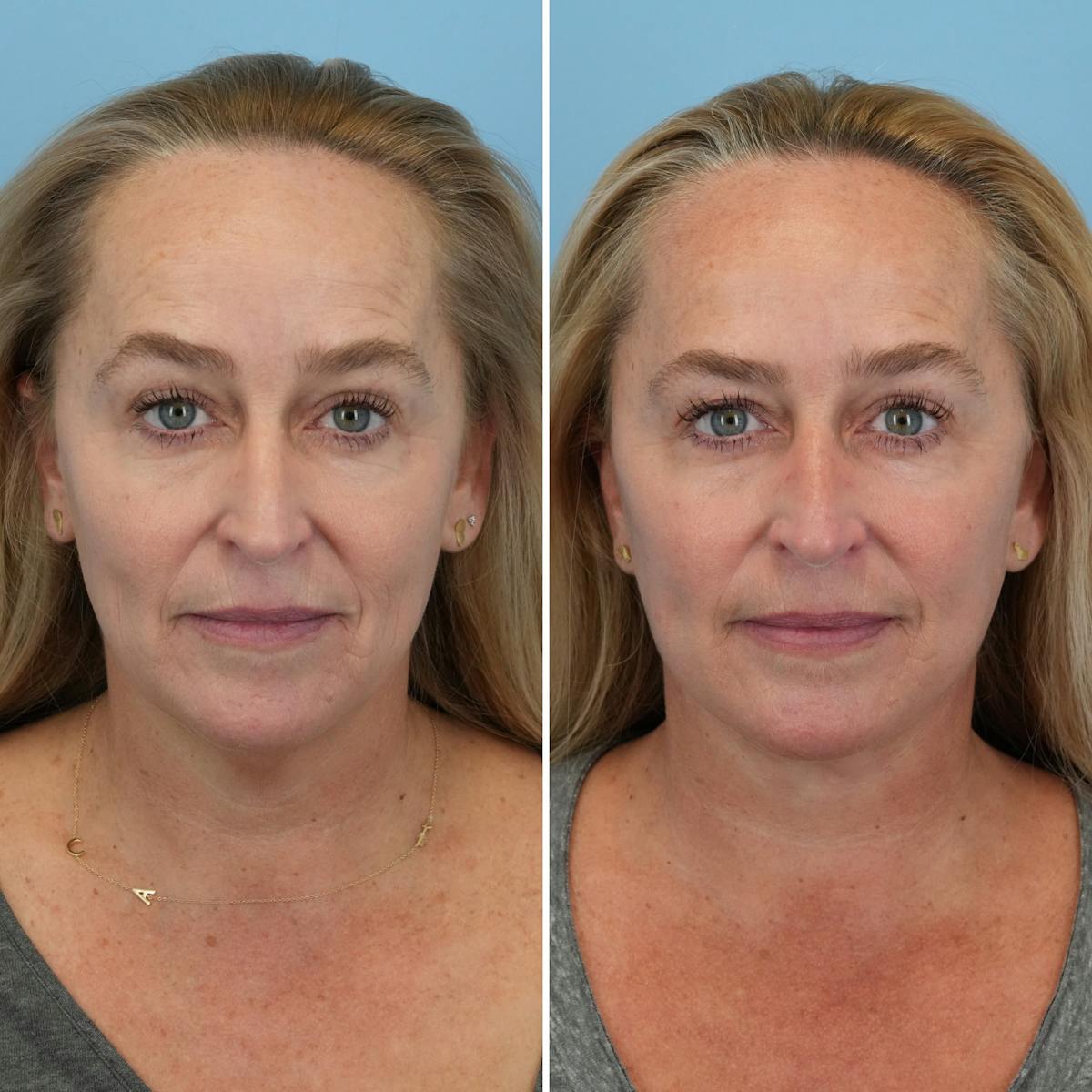 Facelift Before & After Gallery - Patient 373888 - Image 1