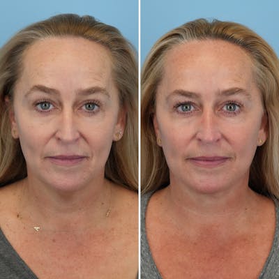 Facelift Before & After Gallery - Patient 373888 - Image 1