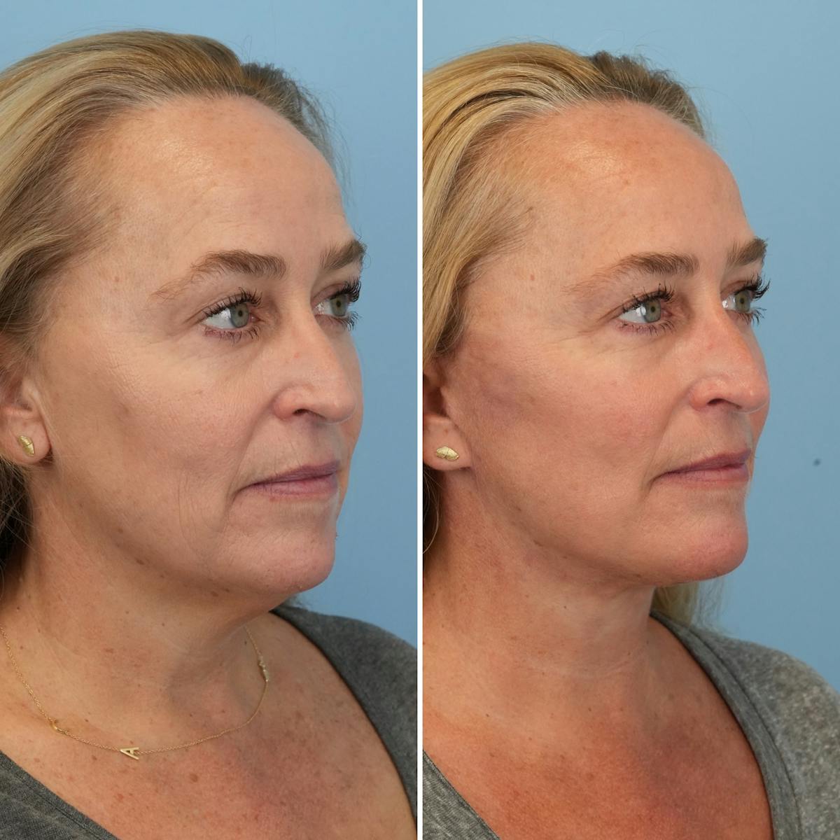 Facelift Before & After Gallery - Patient 373888 - Image 2