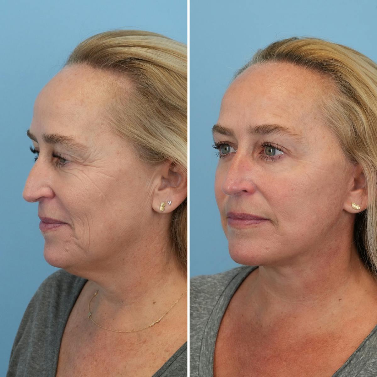 Facelift Before & After Gallery - Patient 373888 - Image 4