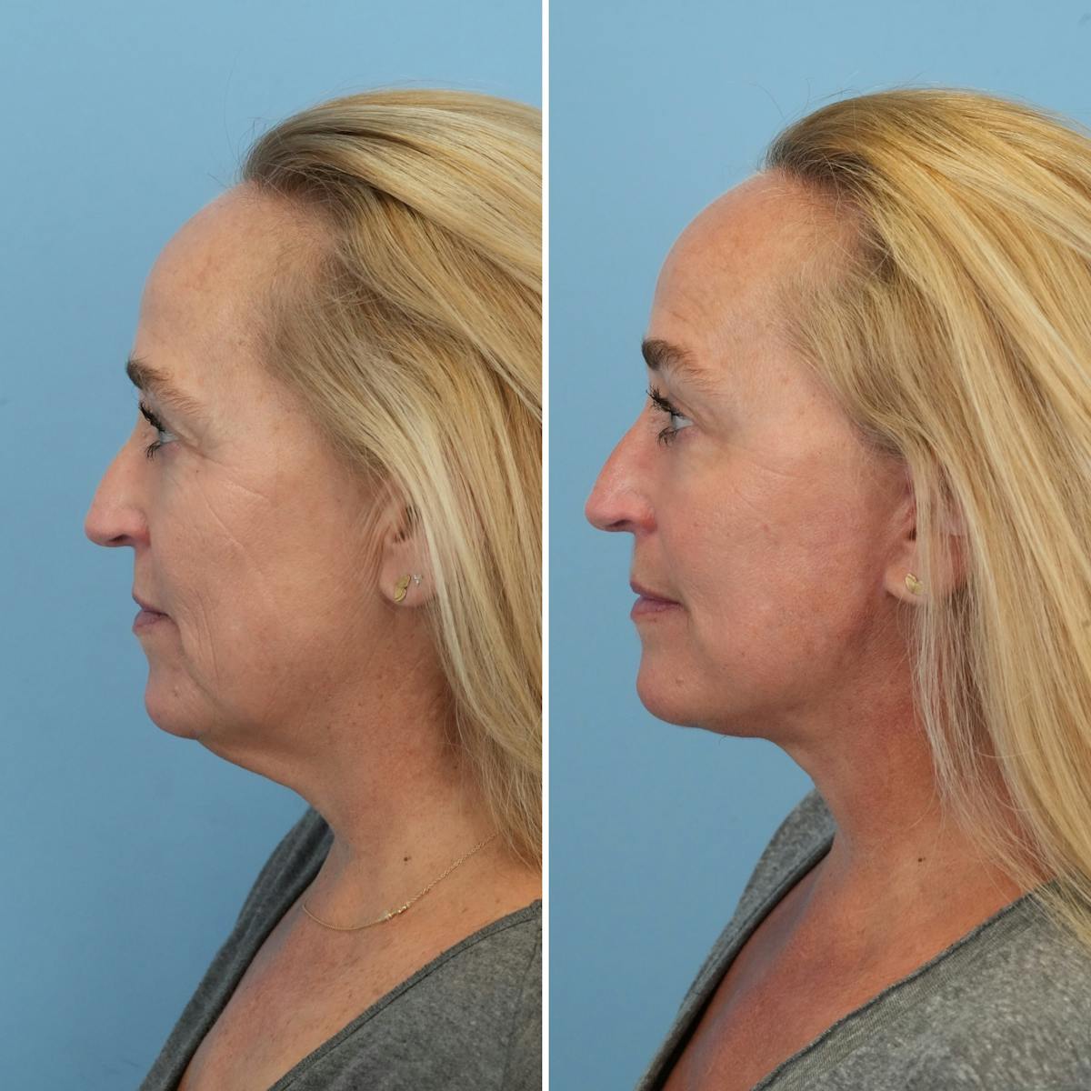 Facelift Before & After Gallery - Patient 373888 - Image 5