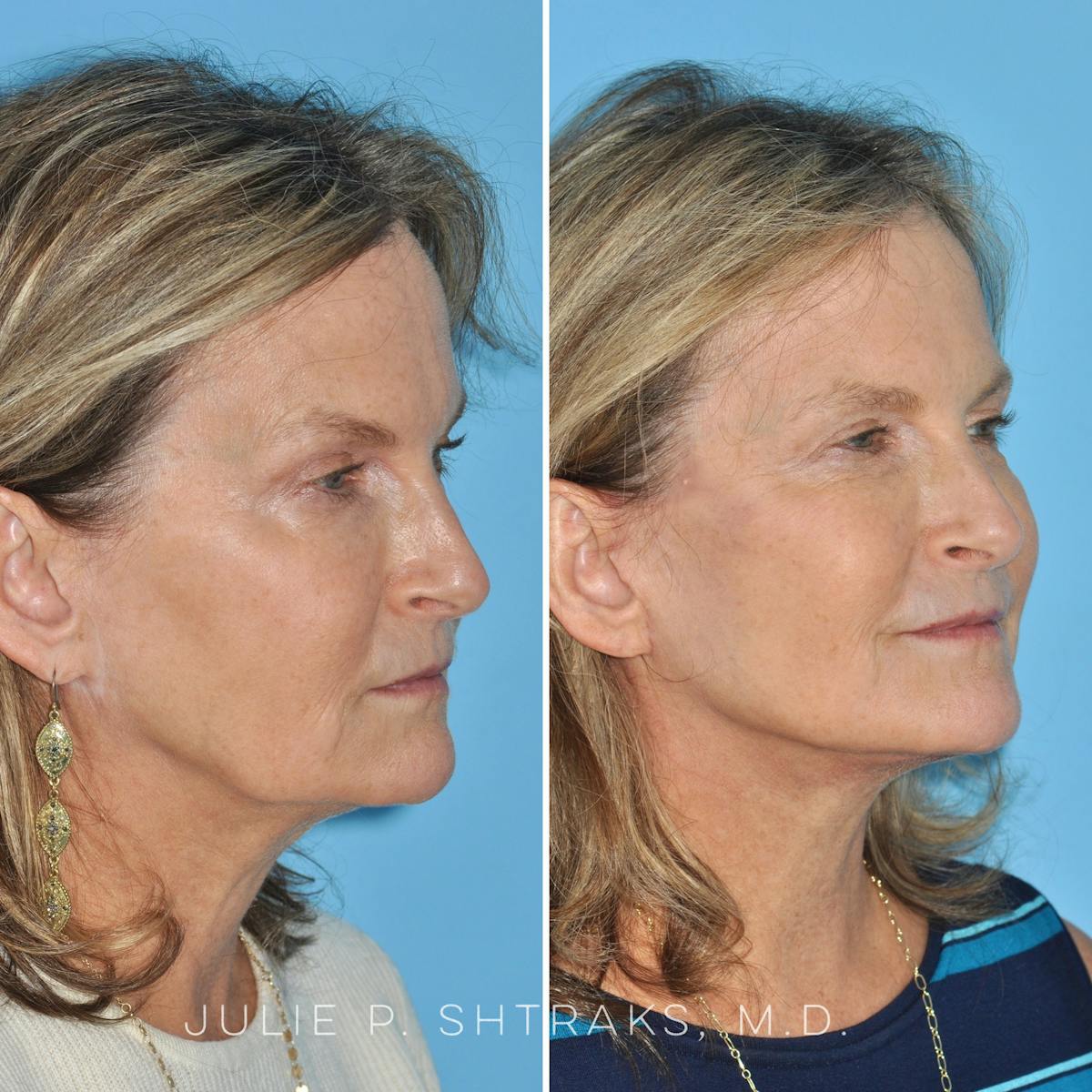 Facelift Before & After Gallery - Patient 368608 - Image 2