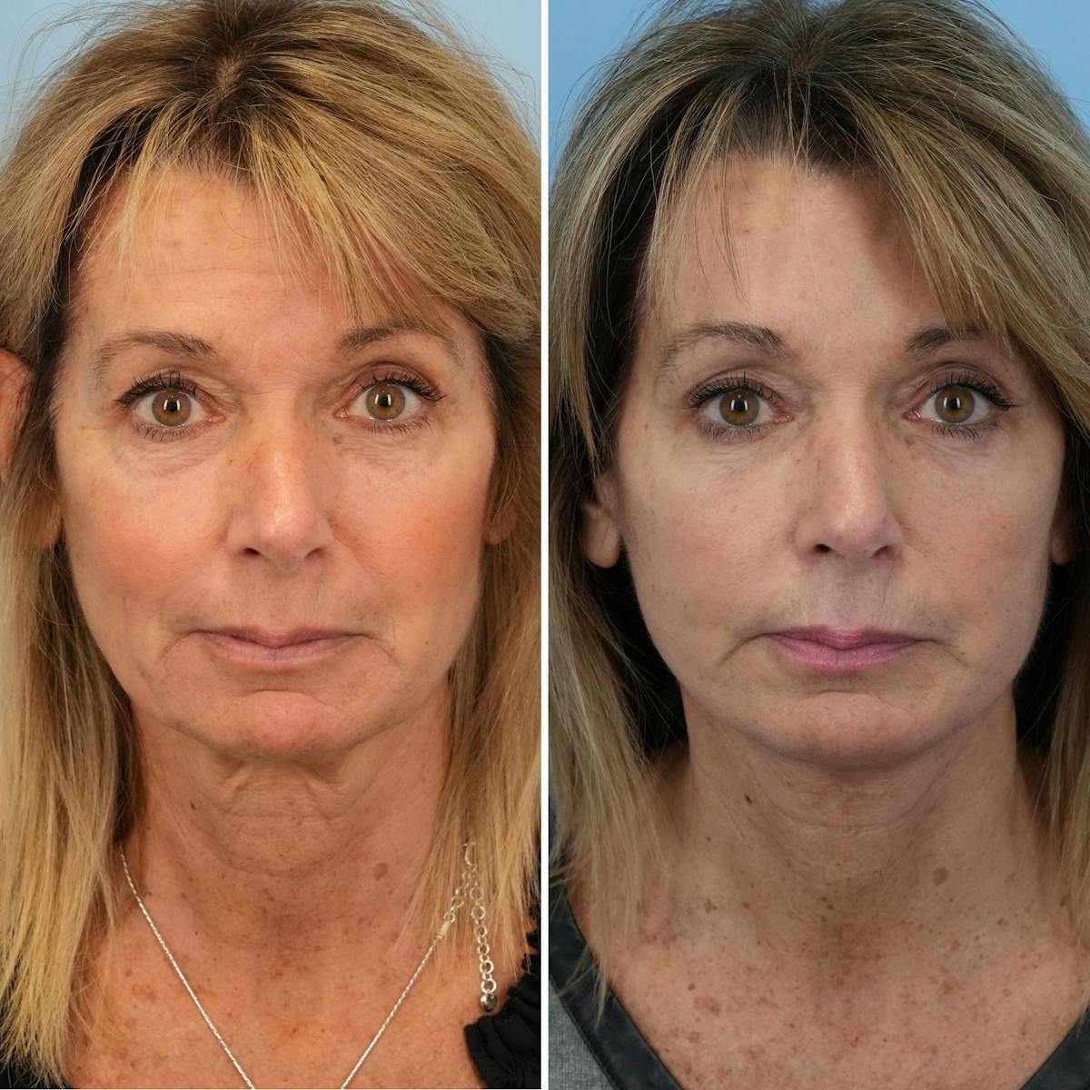 Facelift Before & After Gallery - Patient 226586 - Image 1