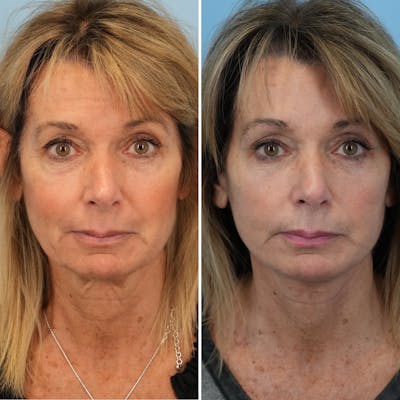 Facelift Before & After Gallery - Patient 226586 - Image 1