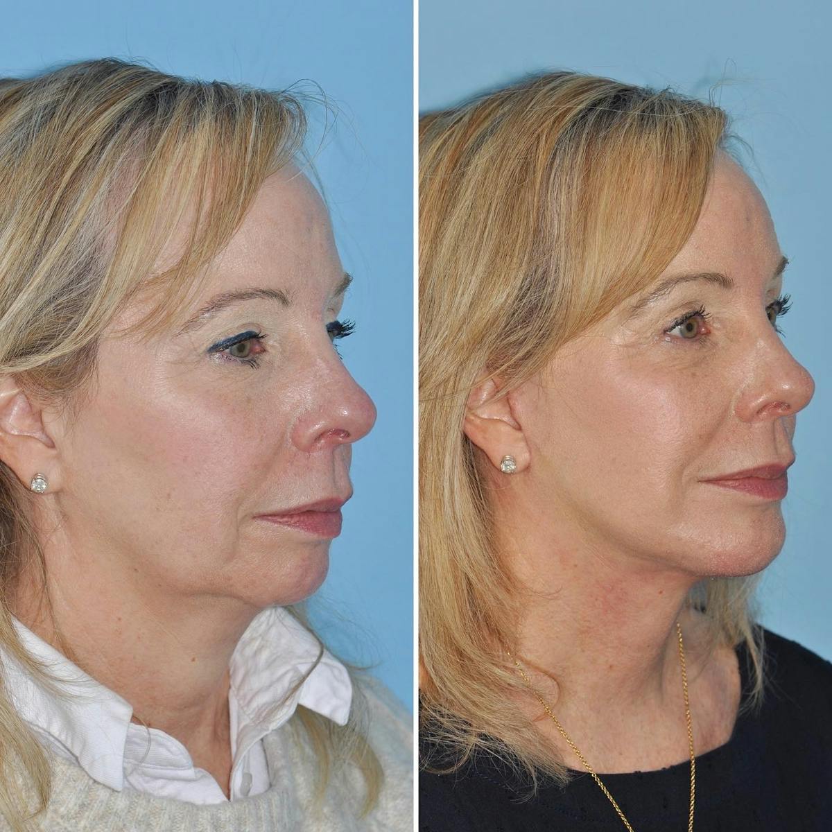 Facelift Before & After Gallery - Patient 201180 - Image 2