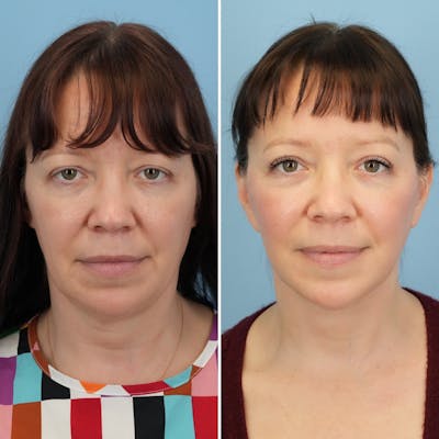 Facelift Before & After Gallery - Patient 196236 - Image 1