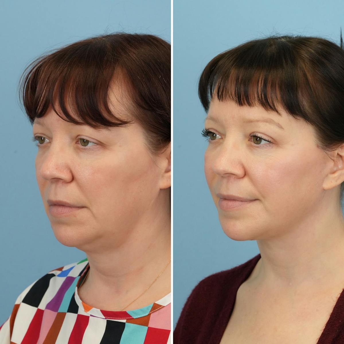 Facelift Before & After Gallery - Patient 196236 - Image 2