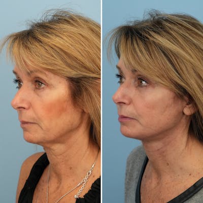 Facelift Before & After Gallery - Patient 335168 - Image 1