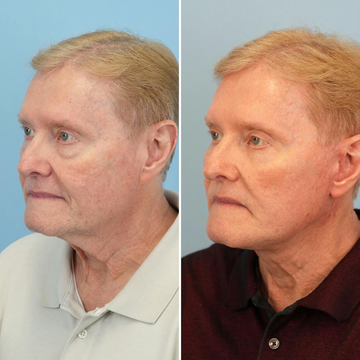 Facelift Before & After Gallery - Patient 118424 - Image 1