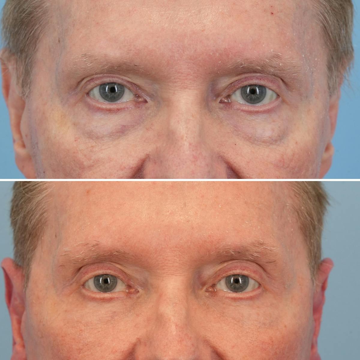 Facelift Before & After Gallery - Patient 118424 - Image 5