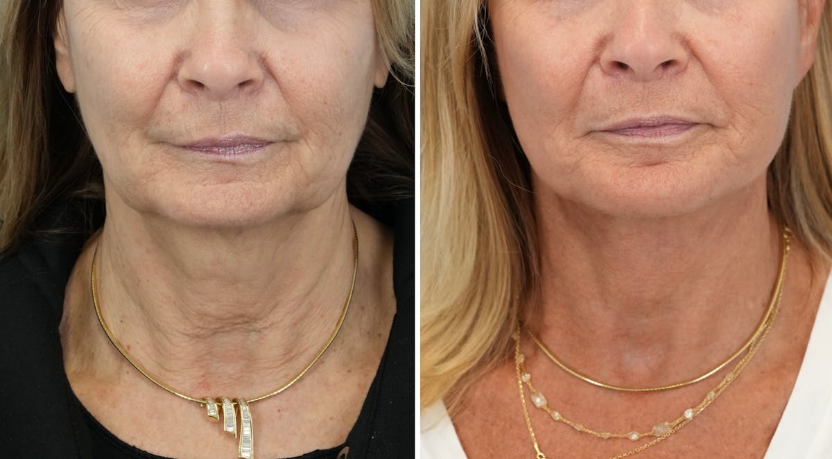 Facelift Before & After Gallery - Patient 321106 - Image 1