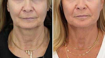 Facelift Before & After Gallery - Patient 321106 - Image 1