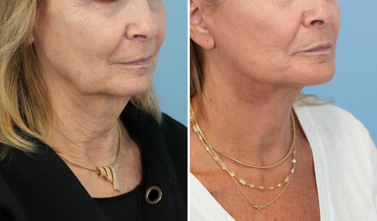 Facelift Before & After Gallery - Patient 321106 - Image 2