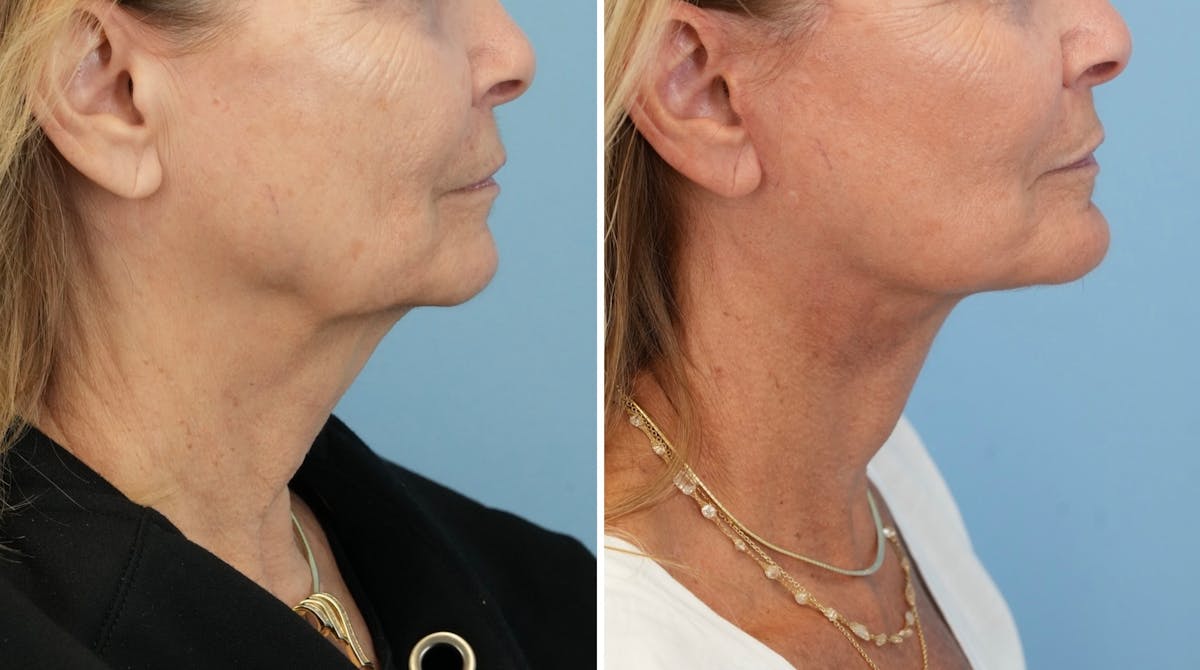 Facelift Before & After Gallery - Patient 321106 - Image 3
