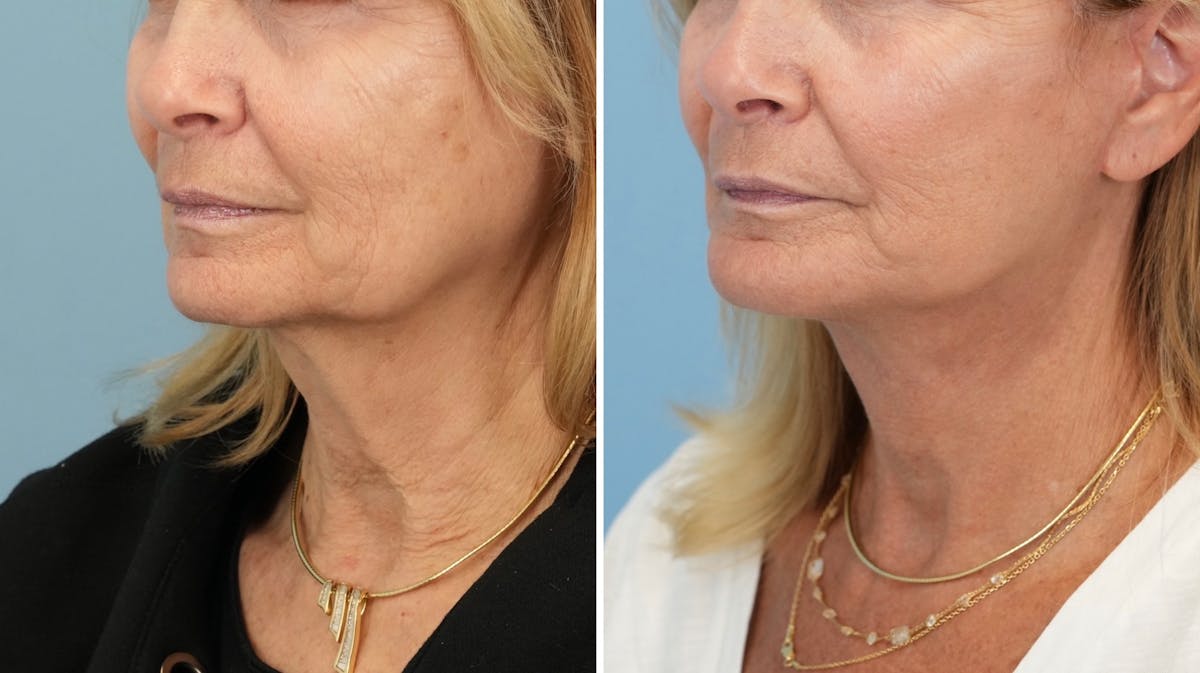 Facelift Before & After Gallery - Patient 321106 - Image 4