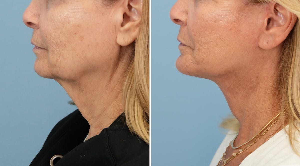 Facelift Before & After Gallery - Patient 321106 - Image 5