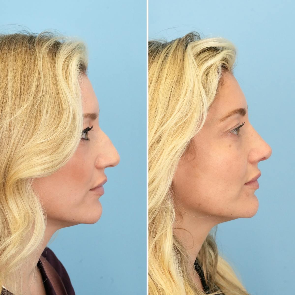 Rhinoplasty Before & After Gallery - Patient 967858 - Image 1