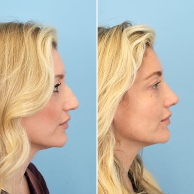 Rhinoplasty Before & After Gallery - Patient 967858 - Image 1