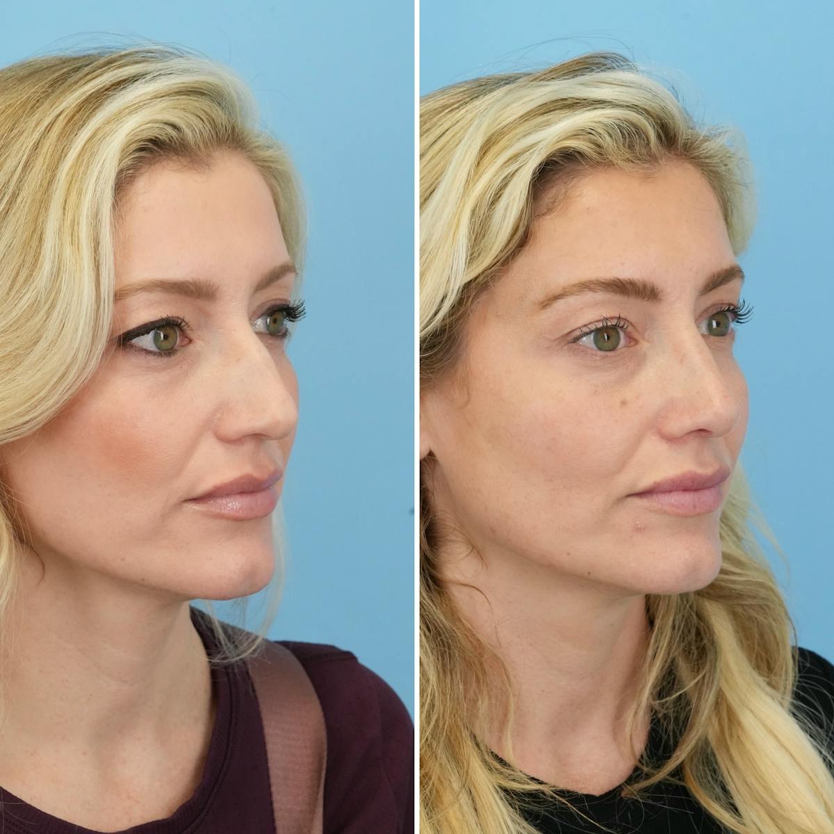 Rhinoplasty Before & After Gallery - Patient 967858 - Image 3