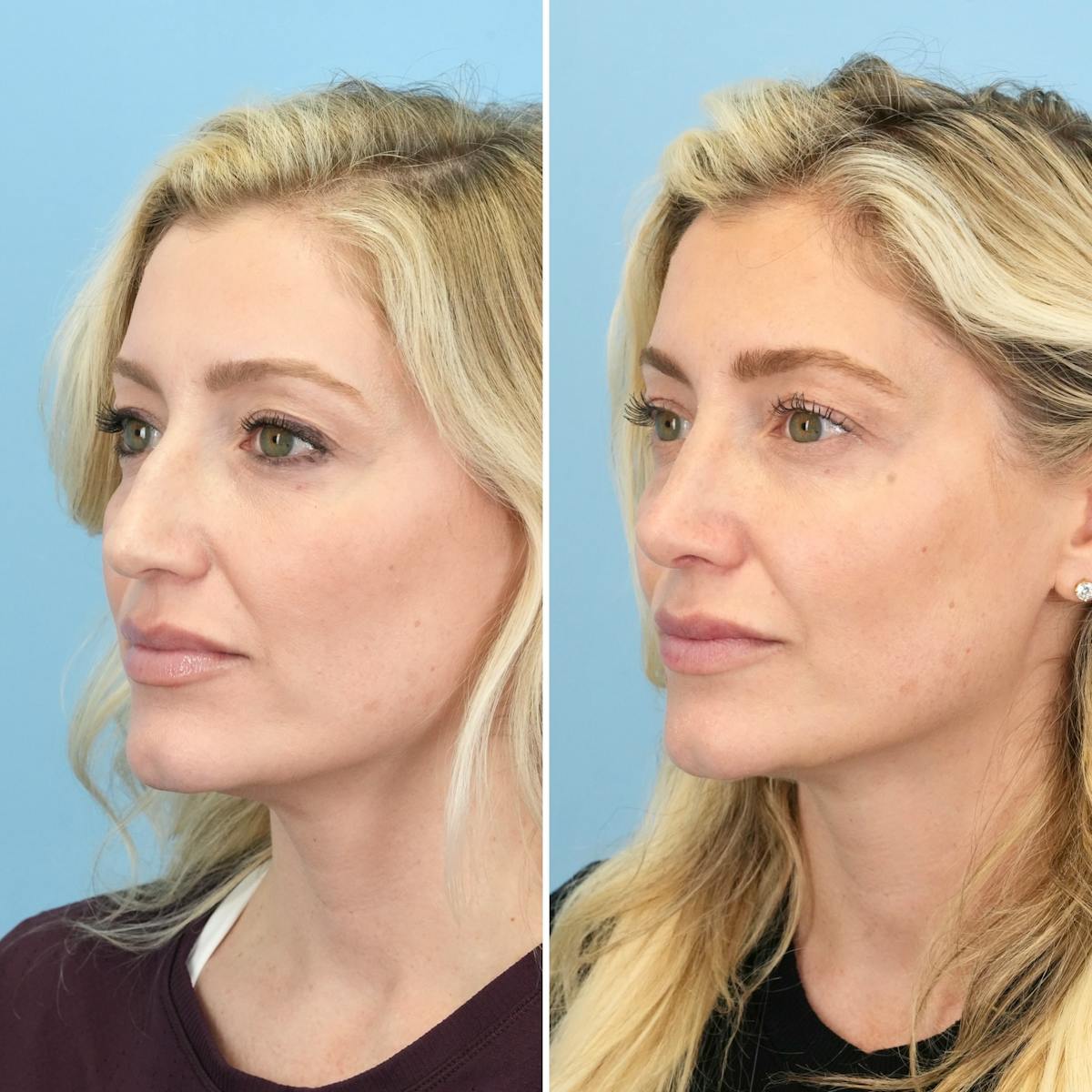 Rhinoplasty Before & After Gallery - Patient 967858 - Image 4