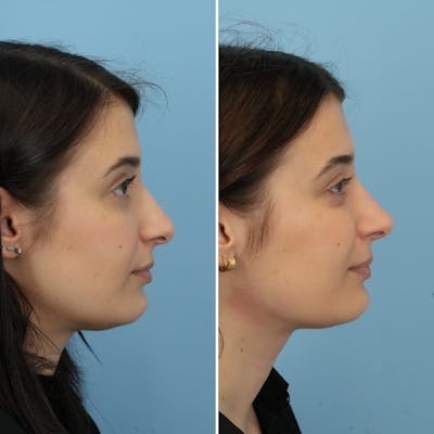 Rhinoplasty Before & After Gallery - Patient 239314 - Image 1