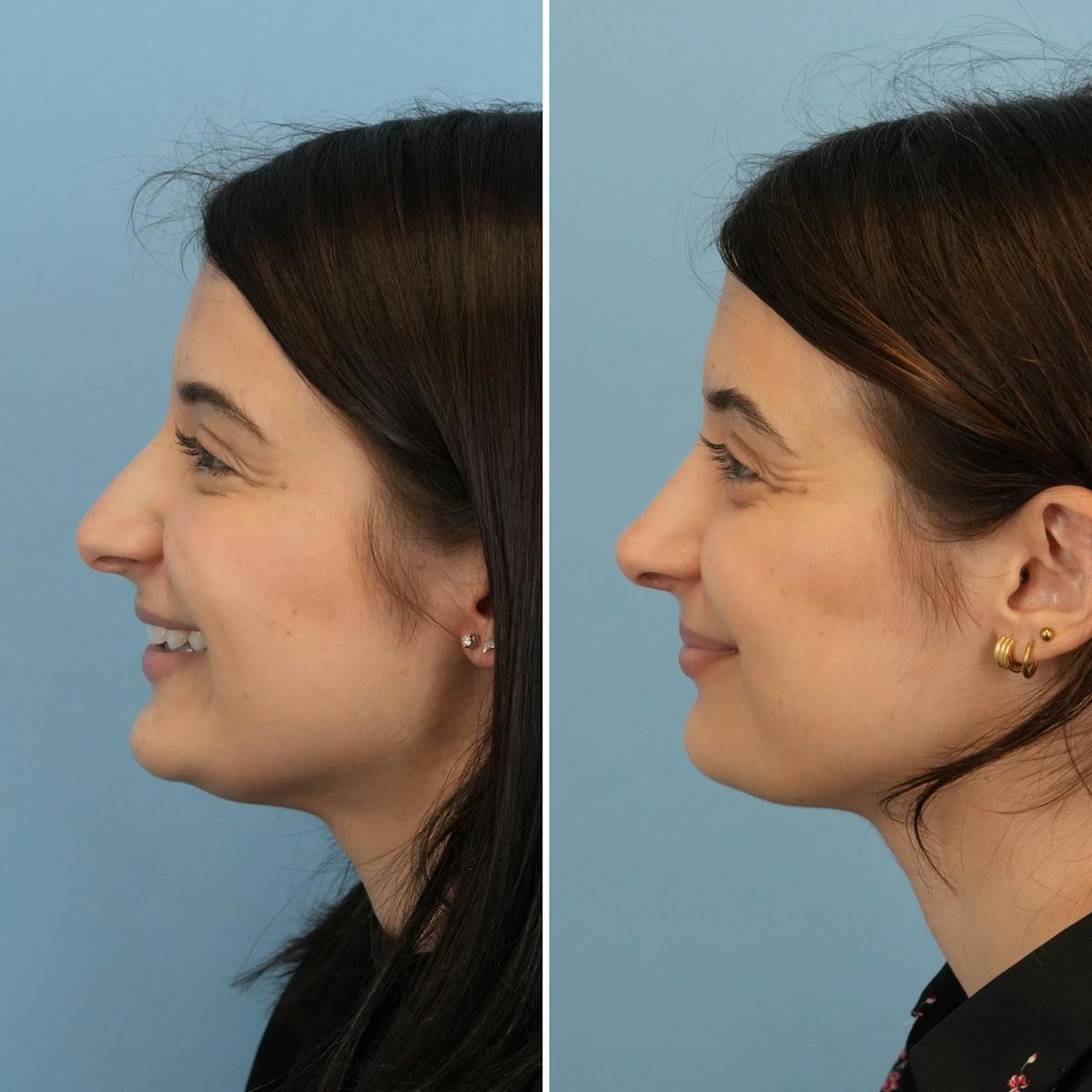 Rhinoplasty Before & After Gallery - Patient 239314 - Image 6
