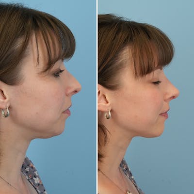 Rhinoplasty Before & After Gallery - Patient 407625 - Image 1