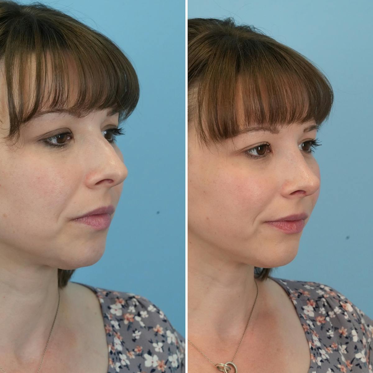 Rhinoplasty Before & After Gallery - Patient 407625 - Image 3