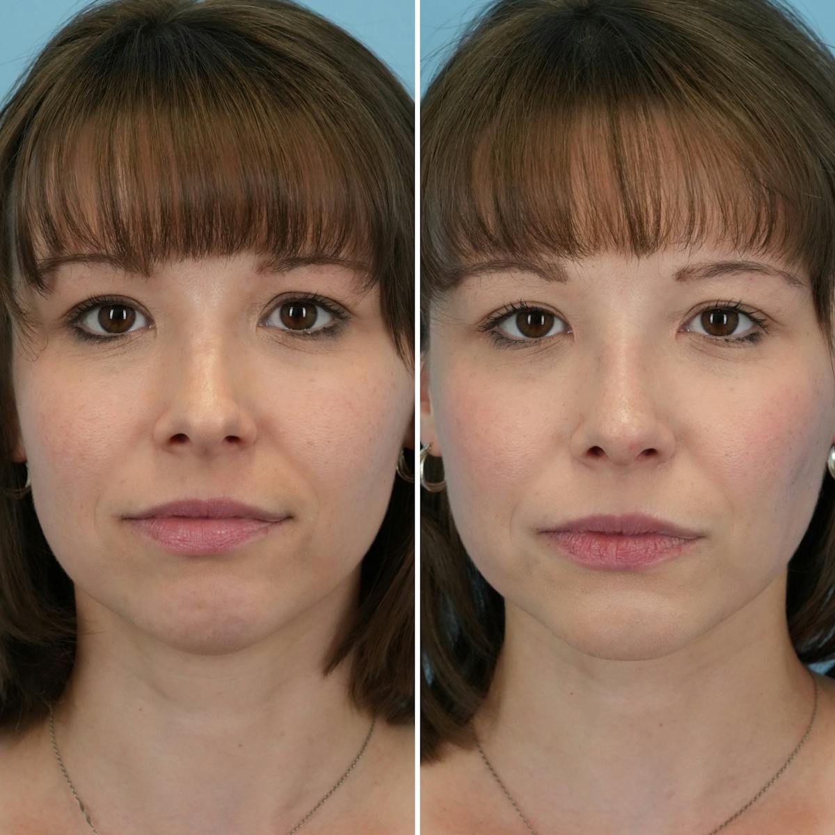 Rhinoplasty Before & After Gallery - Patient 407625 - Image 4