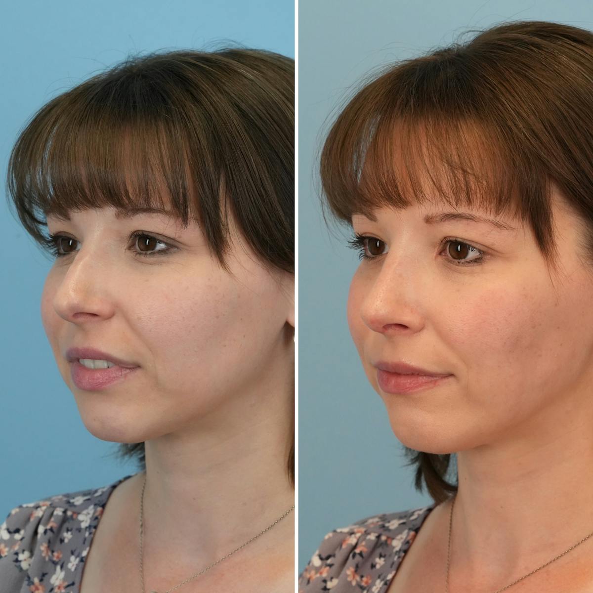 Rhinoplasty Before & After Gallery - Patient 407625 - Image 5