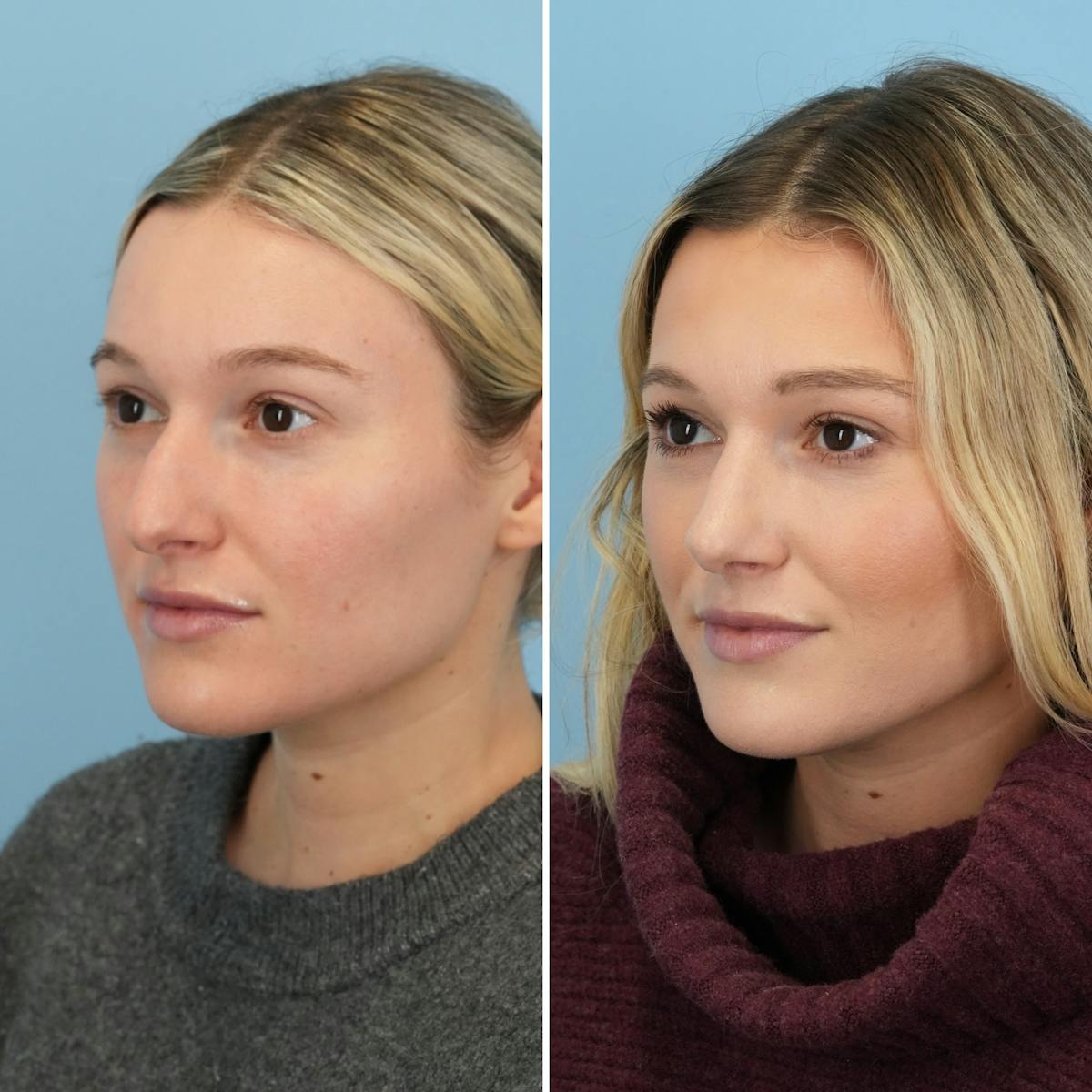 Rhinoplasty Before & After Gallery - Patient 129958 - Image 5