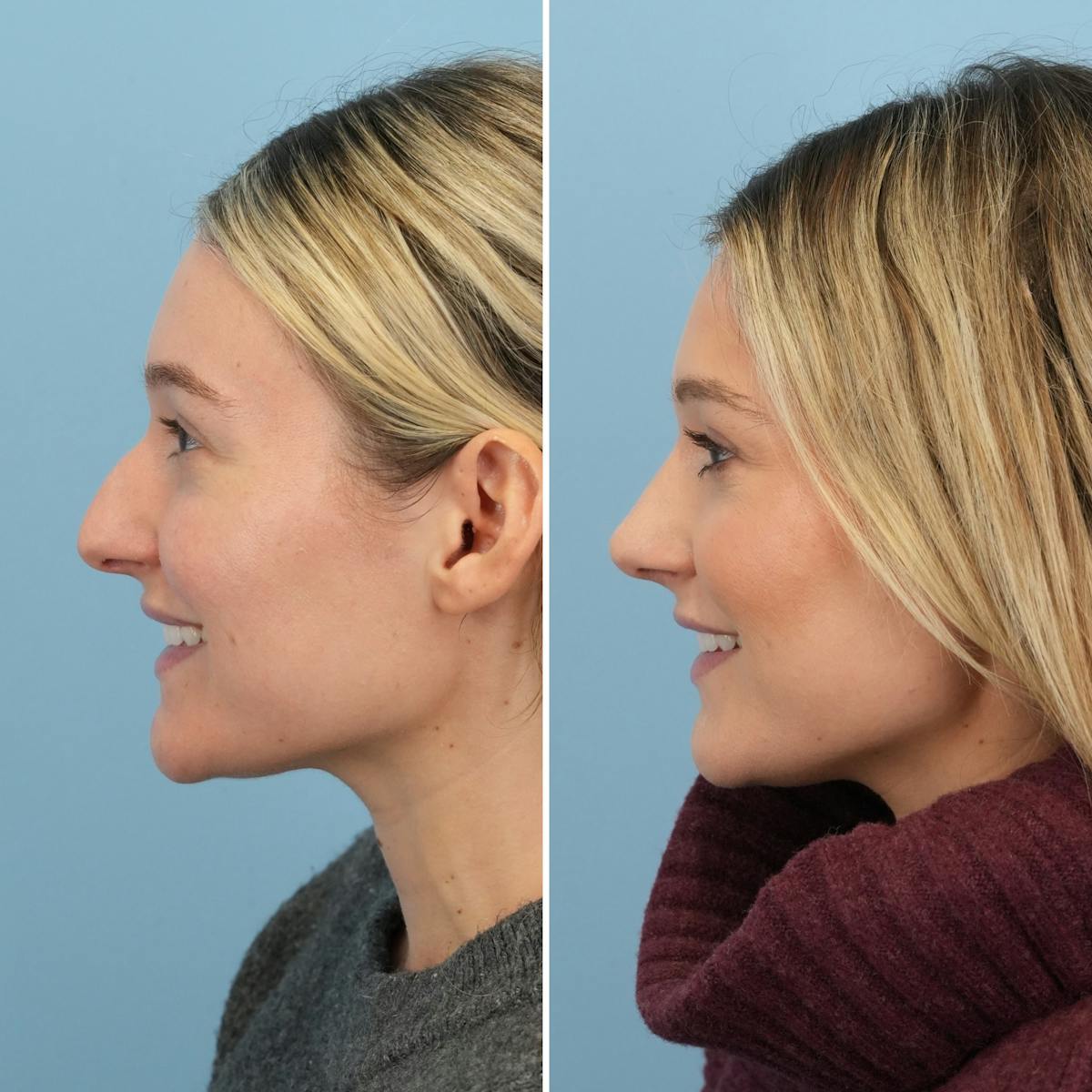 Rhinoplasty Before & After Gallery - Patient 129958 - Image 6