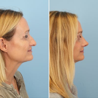 Rhinoplasty Before & After Gallery - Patient 231088 - Image 1