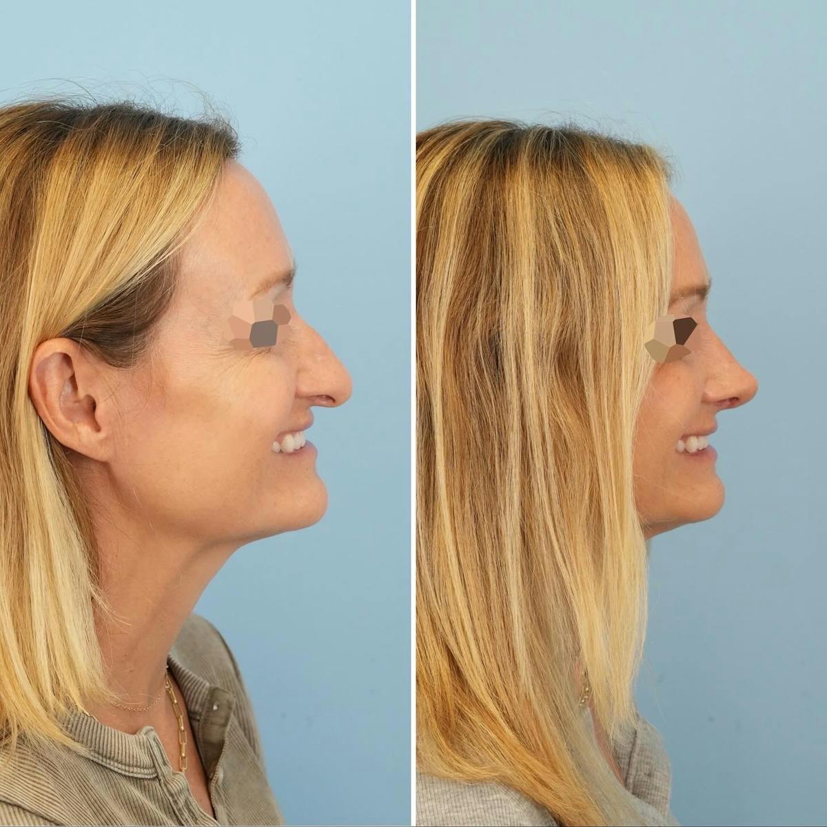 Rhinoplasty Before & After Gallery - Patient 231088 - Image 2