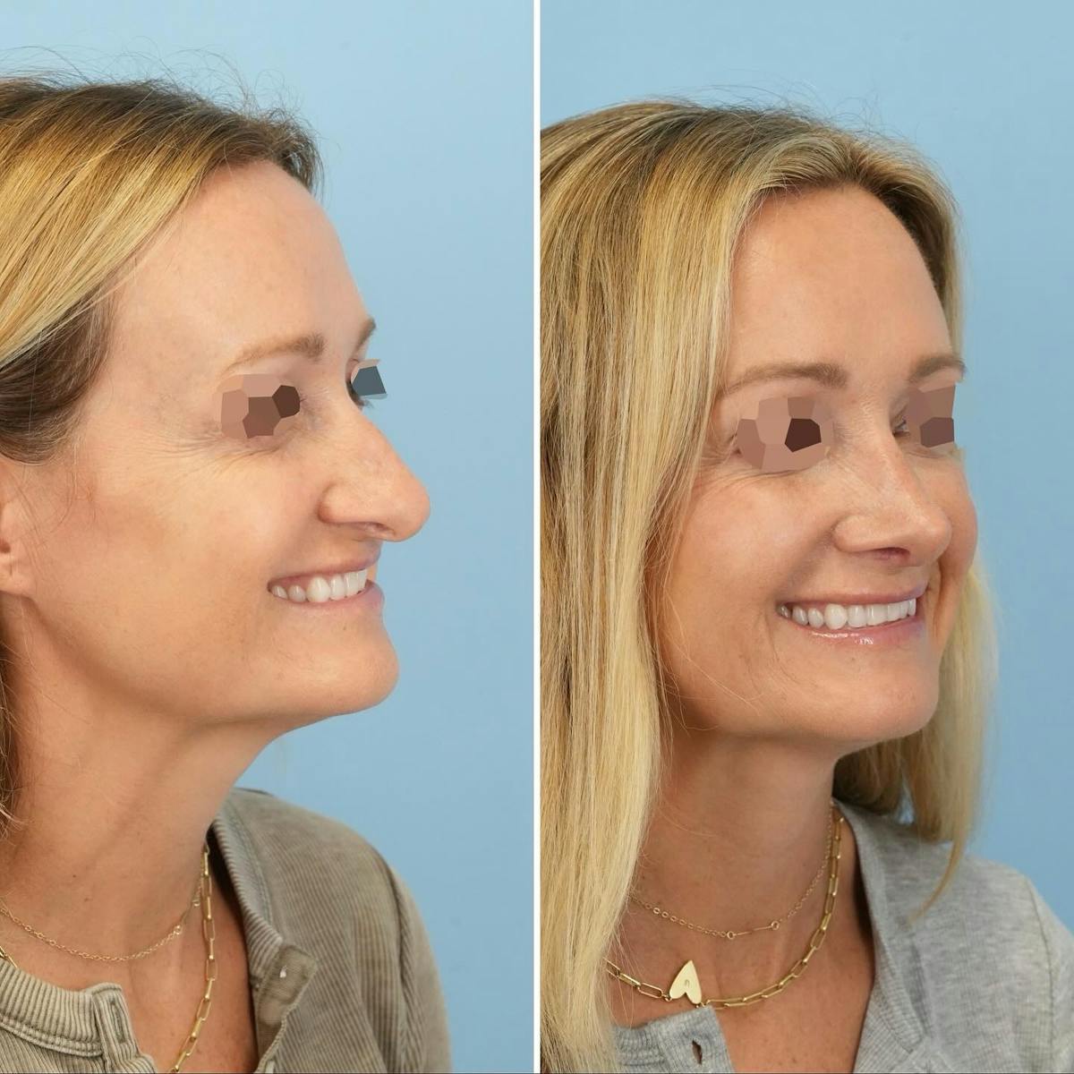 Rhinoplasty Before & After Gallery - Patient 231088 - Image 3