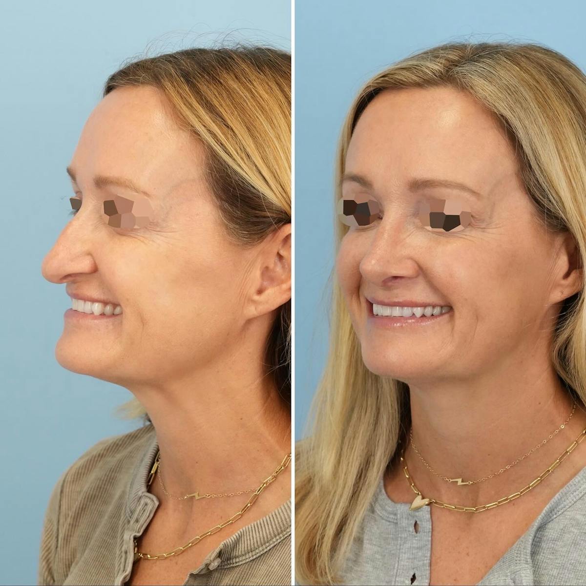 Rhinoplasty Before & After Gallery - Patient 231088 - Image 5