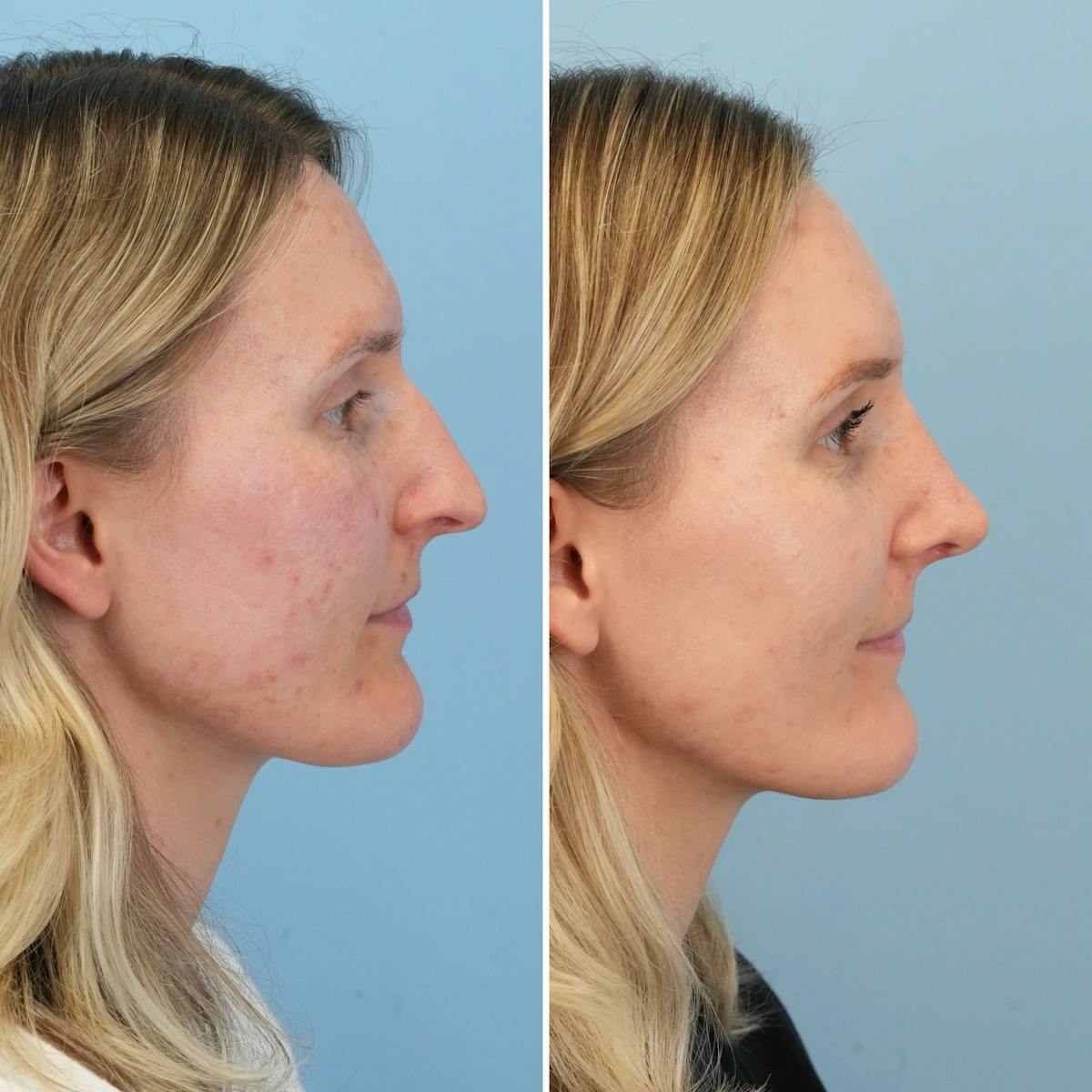 Rhinoplasty Before & After Gallery - Patient 279738 - Image 1