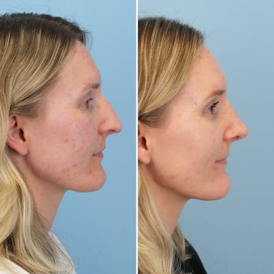 Rhinoplasty Before & After Gallery - Patient 279738 - Image 1