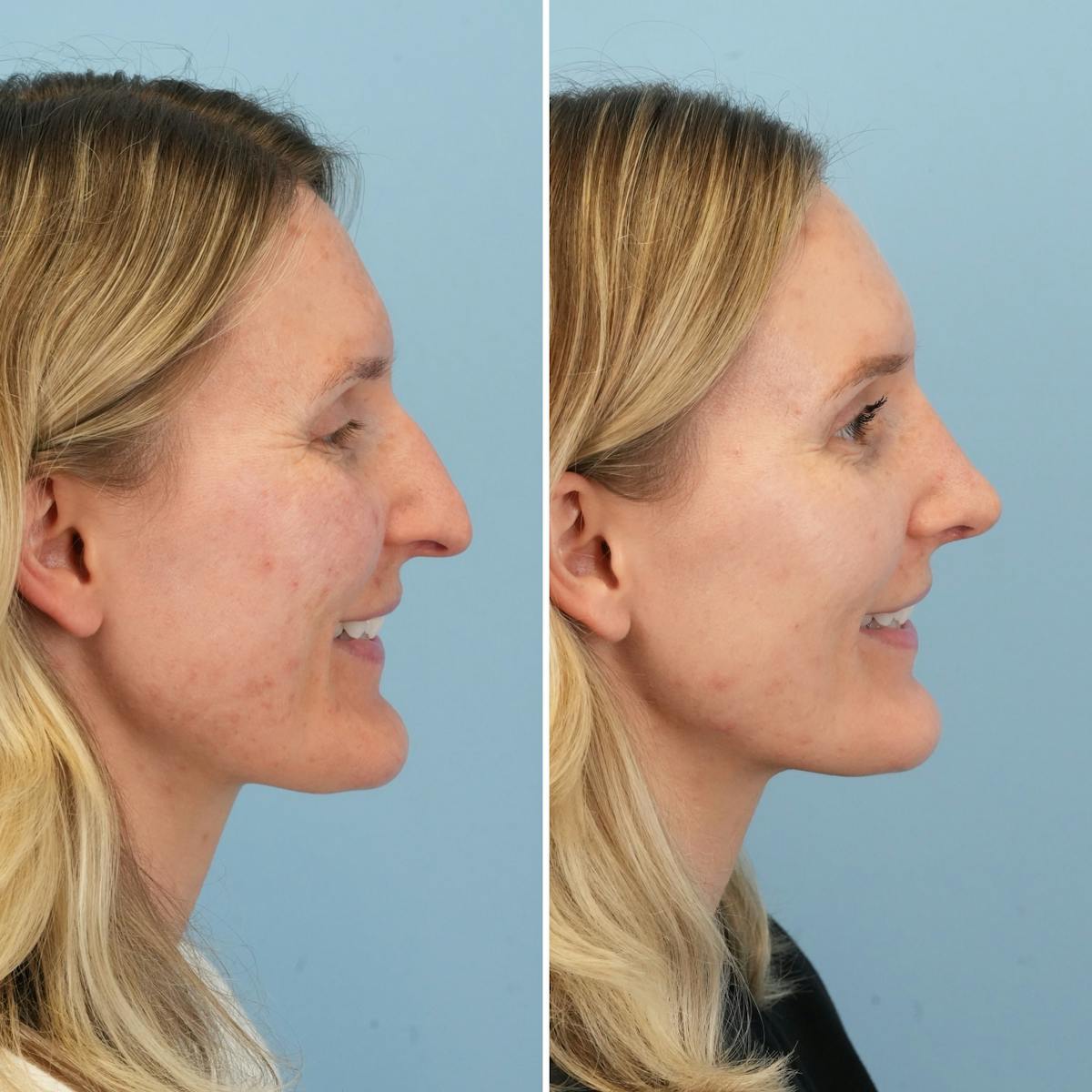 Rhinoplasty Before & After Gallery - Patient 279738 - Image 2