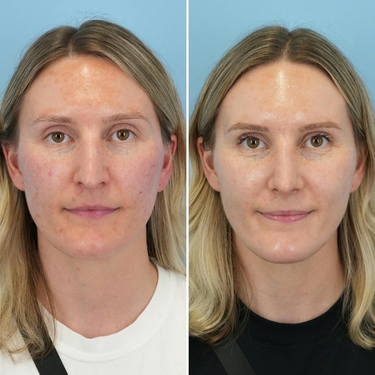 Rhinoplasty Before & After Gallery - Patient 279738 - Image 5