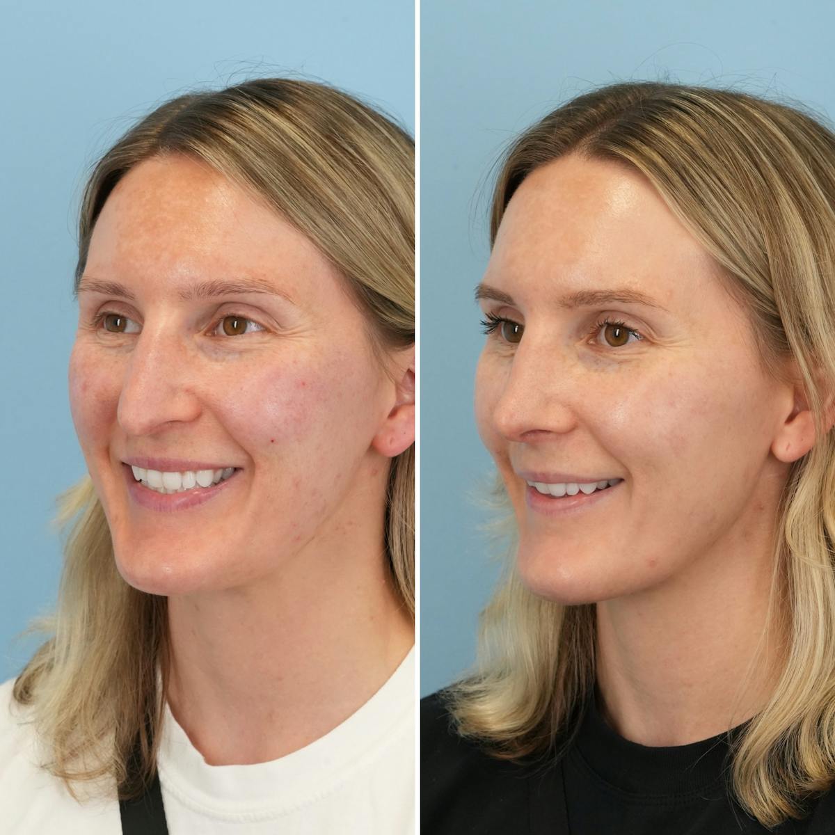 Rhinoplasty Before & After Gallery - Patient 279738 - Image 6