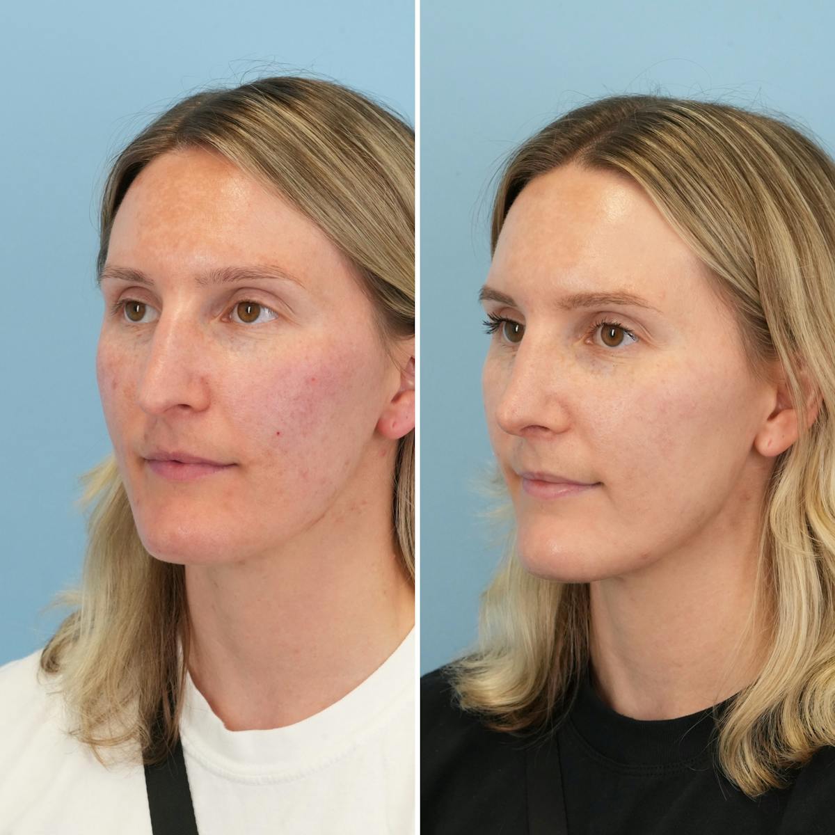 Rhinoplasty Before & After Gallery - Patient 279738 - Image 7